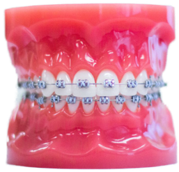 metal braces from Griffin & Errera Orthodontics